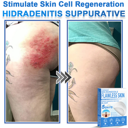 🏆 Celsiora® 2-in-1 Microneedle & Hydrocolloid Patch | Raised Moles,Acne,  Flat Warts & Skin Tags Remover | Improves Wrinkles, Scars & Blemishes | Invisible Pimple Patches for Face & Body