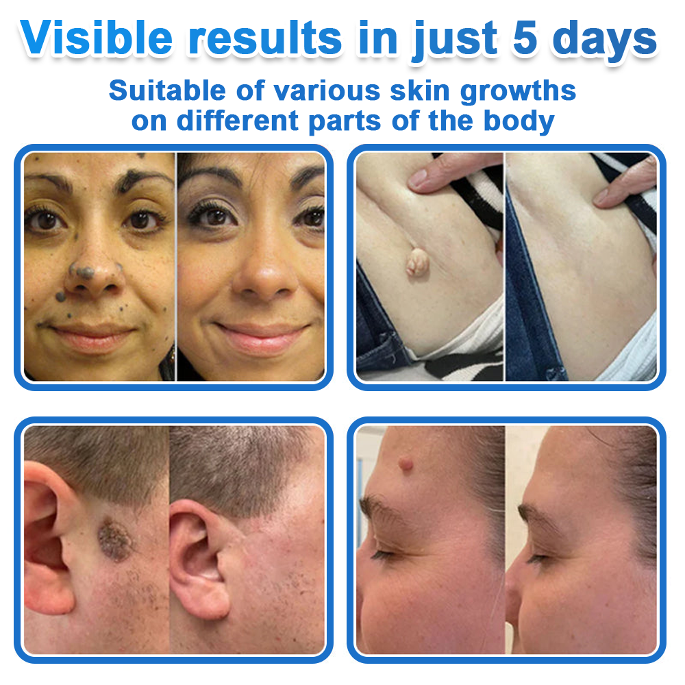 🏆 Celsiora® 2-in-1 Microneedle & Hydrocolloid Patch | Raised Moles,Acne,  Flat Warts & Skin Tags Remover | Improves Wrinkles, Scars & Blemishes | Invisible Pimple Patches for Face & Body