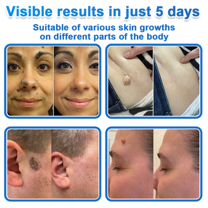 🏆 Celsiora® 2-in-1 Microneedle & Hydrocolloid Patch | Raised Moles,Acne,  Flat Warts & Skin Tags Remover | Improves Wrinkles, Scars & Blemishes | Invisible Pimple Patches for Face & Body
