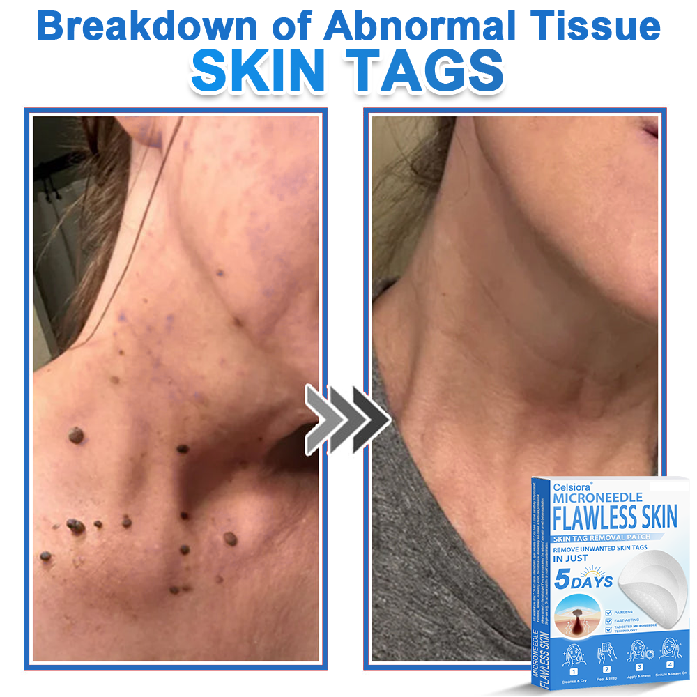 🏆 Celsiora® 2-in-1 Microneedle & Hydrocolloid Patch | Raised Moles,Acne,  Flat Warts & Skin Tags Remover | Improves Wrinkles, Scars & Blemishes | Invisible Pimple Patches for Face & Body