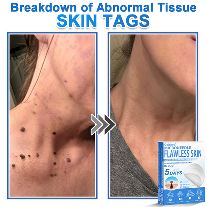 🏆 Celsiora® 2-in-1 Microneedle & Hydrocolloid Patch | Raised Moles,Acne,  Flat Warts & Skin Tags Remover | Improves Wrinkles, Scars & Blemishes | Invisible Pimple Patches for Face & Body