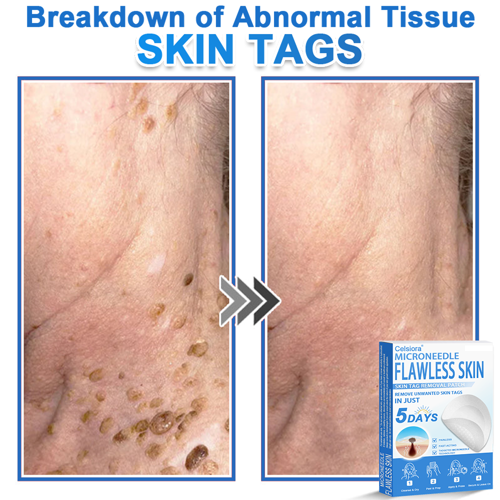 🏆 Celsiora® 2-in-1 Microneedle & Hydrocolloid Patch | Raised Moles,Acne,  Flat Warts & Skin Tags Remover | Improves Wrinkles, Scars & Blemishes | Invisible Pimple Patches for Face & Body