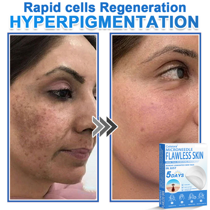 🏆 Celsiora® 2-in-1 Microneedle & Hydrocolloid Patch | Raised Moles,Acne,  Flat Warts & Skin Tags Remover | Improves Wrinkles, Scars & Blemishes | Invisible Pimple Patches for Face & Body